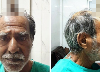 74-летнему индийцу удалили 10-сантиметровый "дьявольский рог" (6 фото)