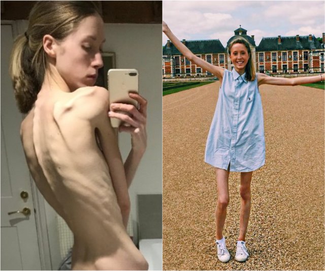 Девушка решила следить за своим питанием и довела себя до анорексии (5 фото)