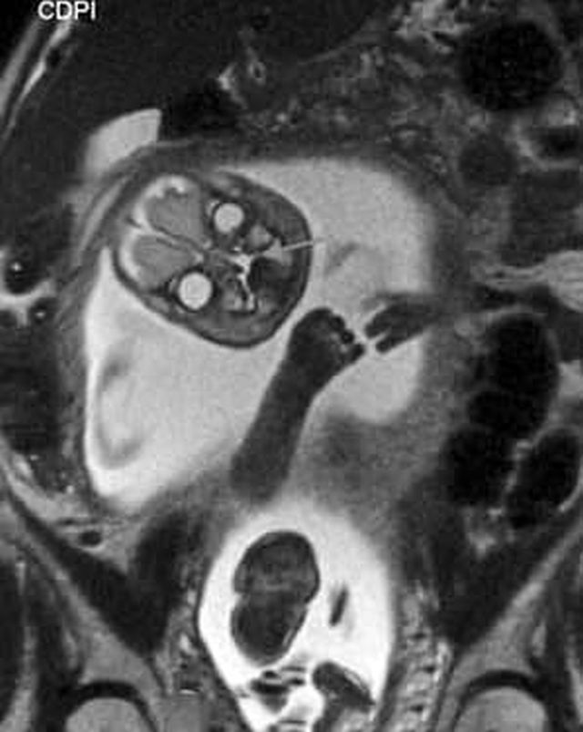 "Поздравляем, у вас демон": жуткий МРТ-снимок беременной женщины (3 фото)
