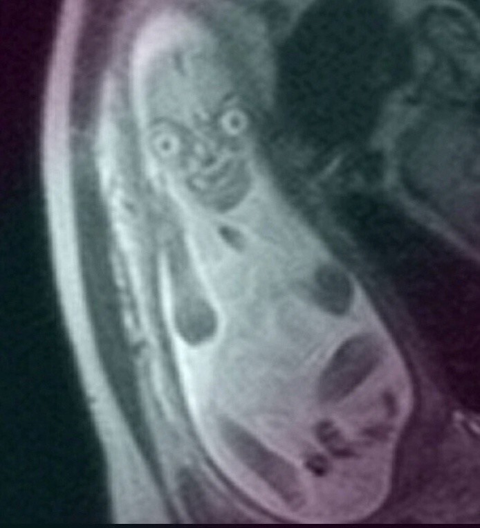 "Весь в отца!": как выглядят внутриутробные снимки детей, сделанные с помощью МРТ (6 фото)