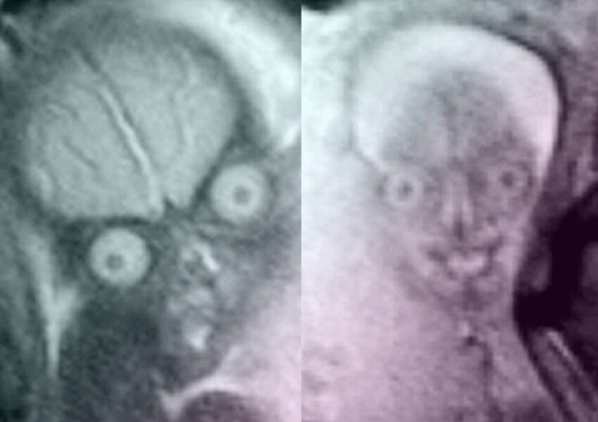 "Весь в отца!": как выглядят внутриутробные снимки детей, сделанные с помощью МРТ (6 фото)