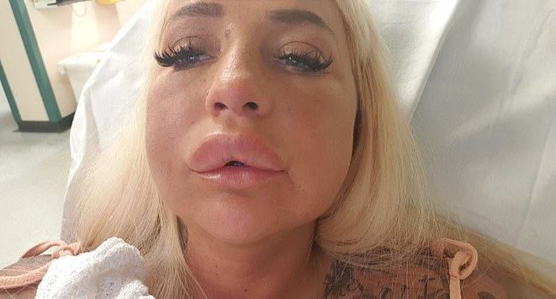 Порнозвезда хотела избавиться от "старых" губ, а получила другой результат (7 фото)