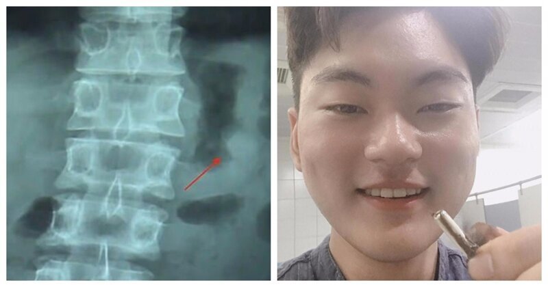 Китаец проглотил наушник AirPod: удивительные приключения гаджета в пищеварительной системе (4 фото)