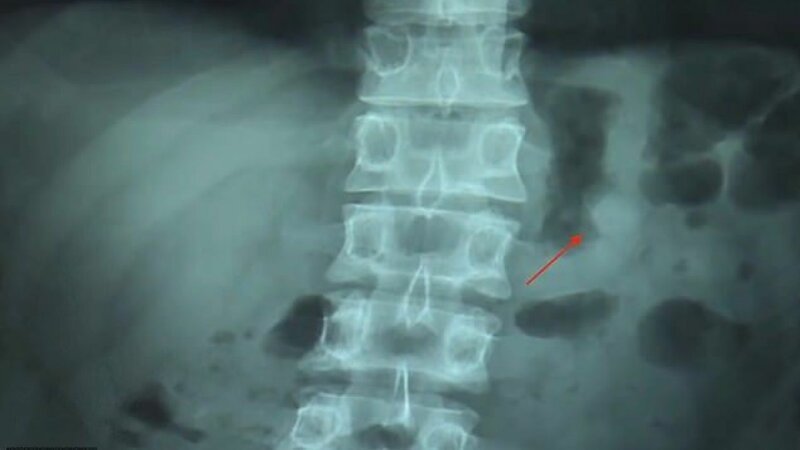 Китаец проглотил наушник AirPod: удивительные приключения гаджета в пищеварительной системе (4 фото)