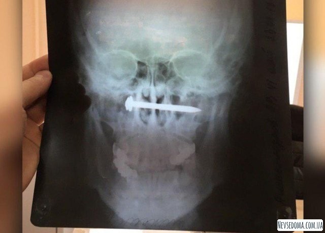 Доктор, у меня голова болит. Житель Хабаровского края два года прожил гвоздем в носоглотке