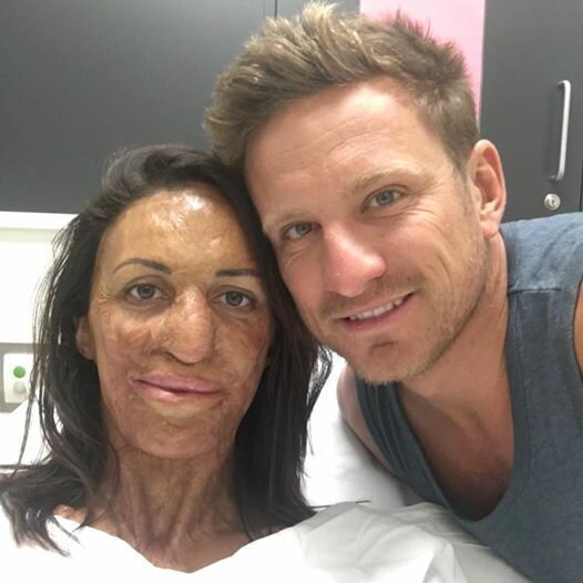 История об истинной любви: мужчина сделал предложение девушке, 65% тела которой обезображено ожогами (7 фото + 1 видео)