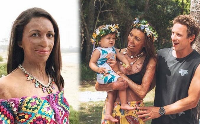 История об истинной любви: мужчина сделал предложение девушке, 65% тела которой обезображено ожогами (7 фото + 1 видео)