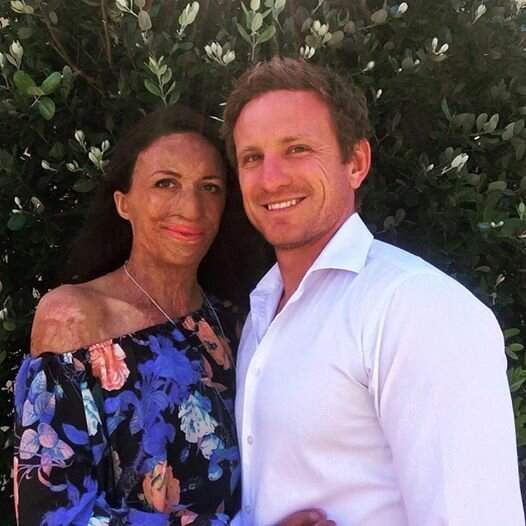 История об истинной любви: мужчина сделал предложение девушке, 65% тела которой обезображено ожогами (7 фото + 1 видео)