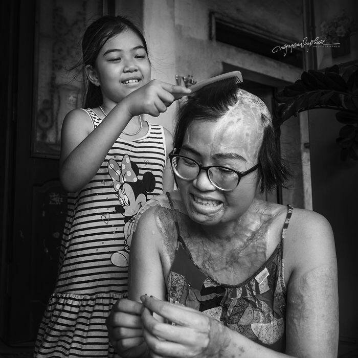 На женщину напал бывший муж и облил кислотой, она могла умереть, но выжила (14 фото) На женщину напал бывший муж и облил кислотой, она могла умереть, но выжила (14 фото)