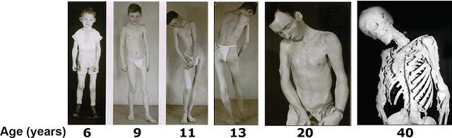 Каменные люди: фибродисплазия - история болезни (12 фото)