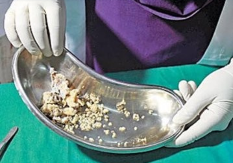 У семилетнего мальчика врачи удалили 526 лишних зубов (8 фото + 1 видео)