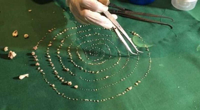 У семилетнего мальчика врачи удалили 526 лишних зубов (8 фото + 1 видео)