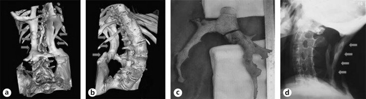 Каменные люди: фибродисплазия - история болезни (12 фото)