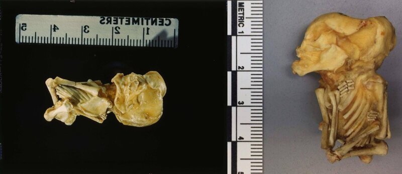 Каменные люди: фибродисплазия - история болезни (12 фото)