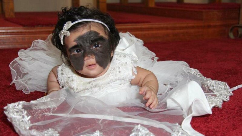 Маленькая американка с родимым пятном в виде «маски Бэтмена» едет лечиться в Россию (6 фото) Маленькая американка с родимым пятном в виде «маски Бэтмена» едет лечиться в Россию (6 фото)