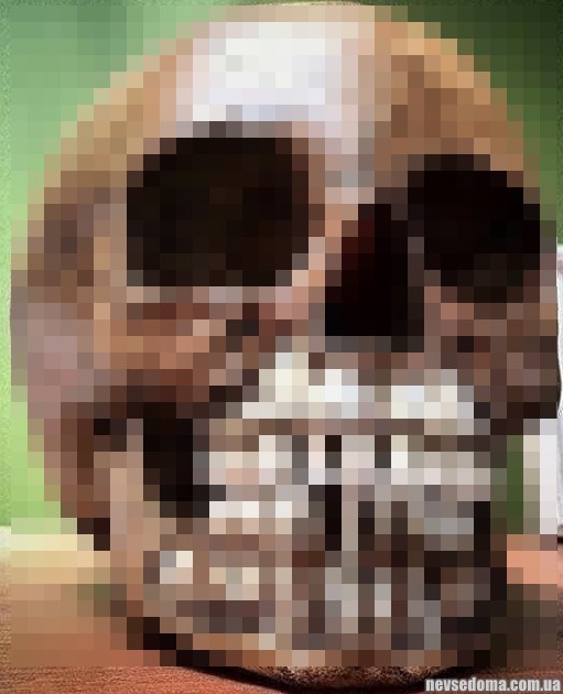 Странности и аномалии человеческого тела, от которых просто глаза лезут на лоб (24 фото)