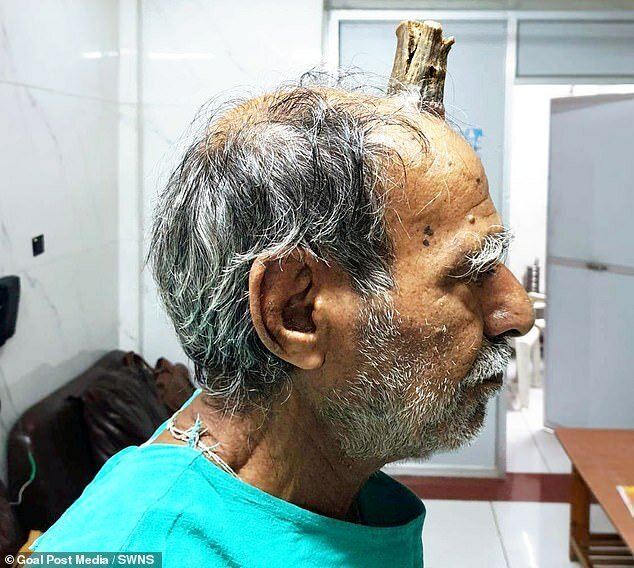 74-летнему индийцу удалили 10-сантиметровый "дьявольский рог" (6 фото)