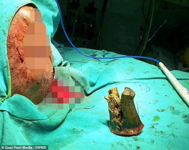 74-летнему индийцу удалили 10-сантиметровый "дьявольский рог" (6 фото)