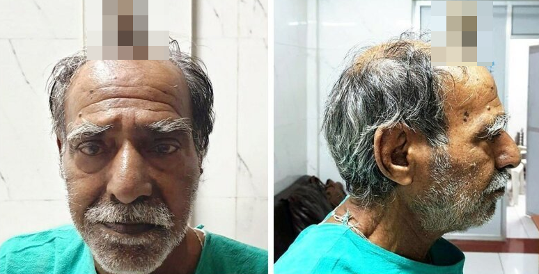 74-летнему индийцу удалили 10-сантиметровый "дьявольский рог" (6 фото)