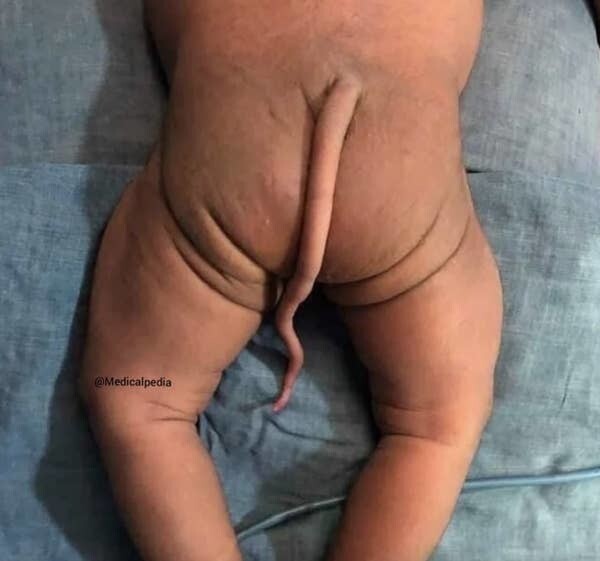 Странности и аномалии человеческого тела, от которых просто глаза лезут на лоб (24 фото)