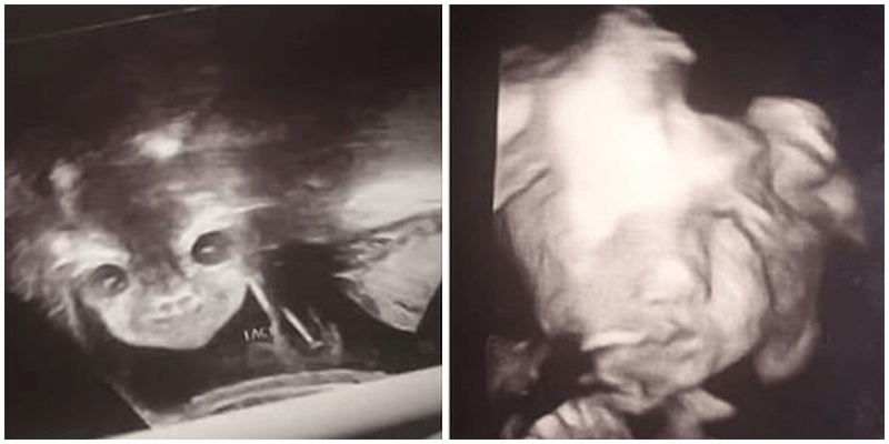 С экрана монитора УЗИ на мать посмотрели огромные глаза (4 фото) С экрана монитора УЗИ на мать посмотрели огромные глаза (4 фото)