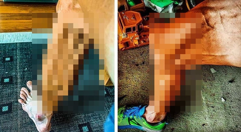 Велосипедист похвастался шокирующим состоянием своих ног после велогонки, борьбы с булимией и дисквалификации за допинг (6 фото) Велосипедист похвастался шокирующим состоянием своих ног после велогонки, борьбы с булимией и дисквалификации за допинг (6 фото)