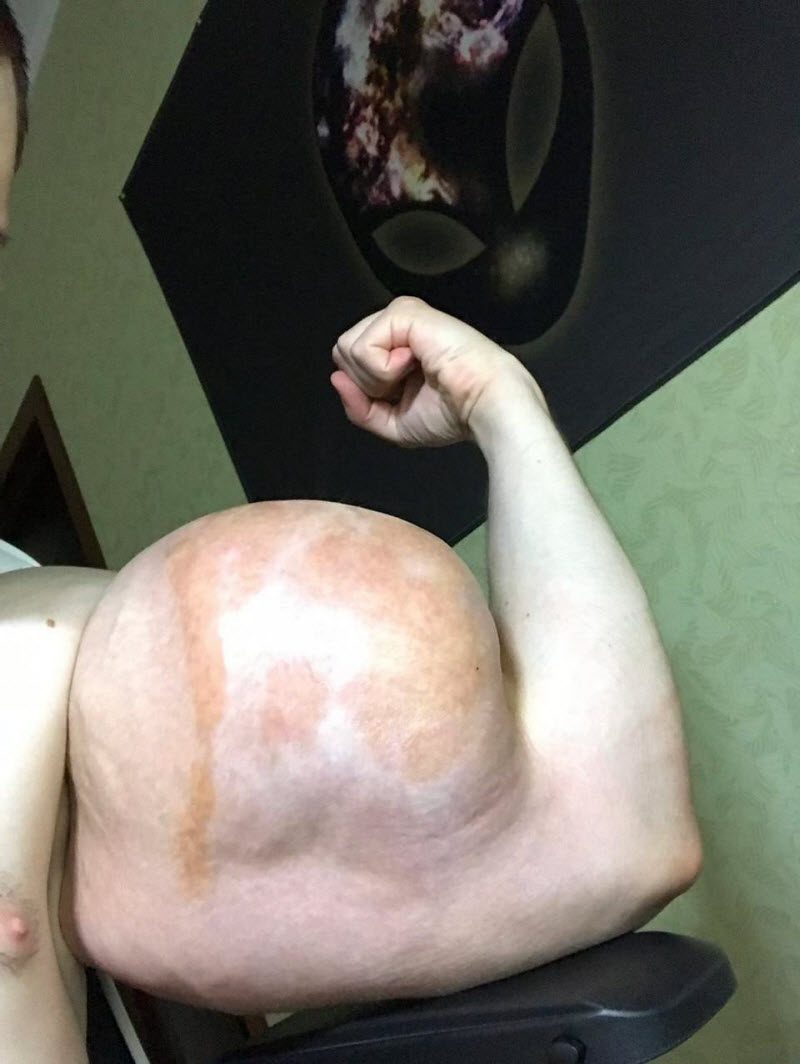 Врачи прооперировали Руки-Базуки, остались просто руки (3 фото)